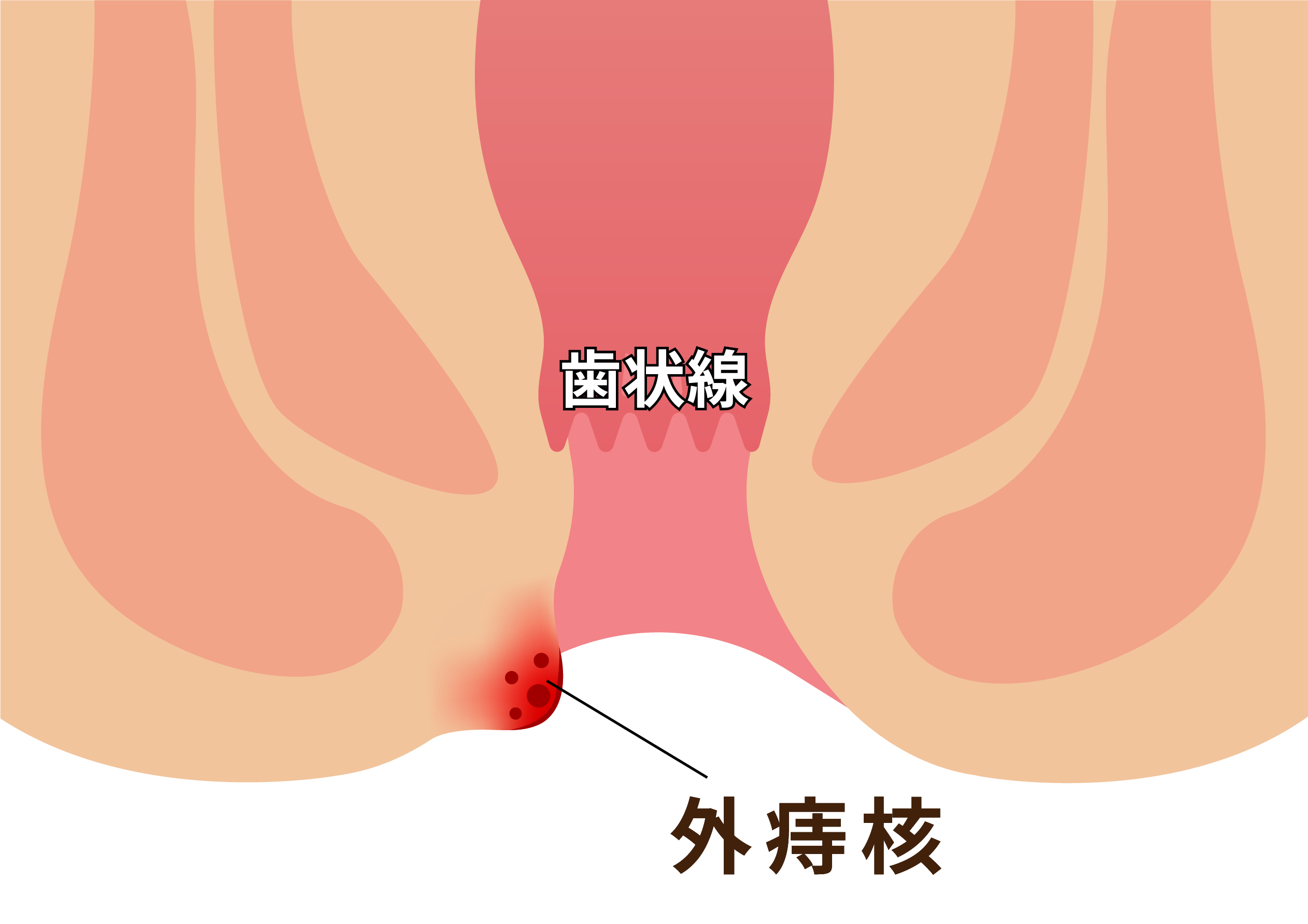 外痔核図示