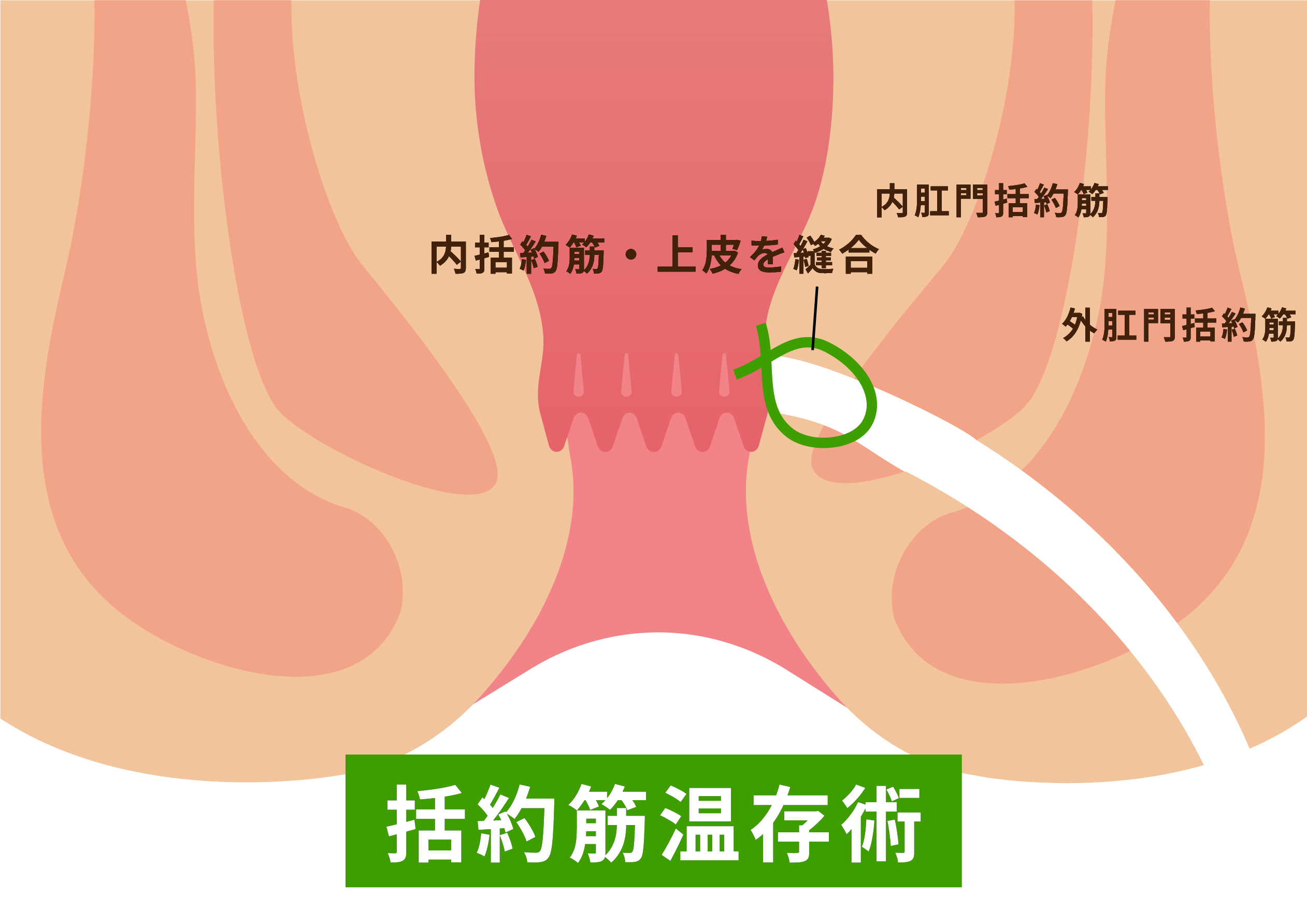 括約筋温存術図示