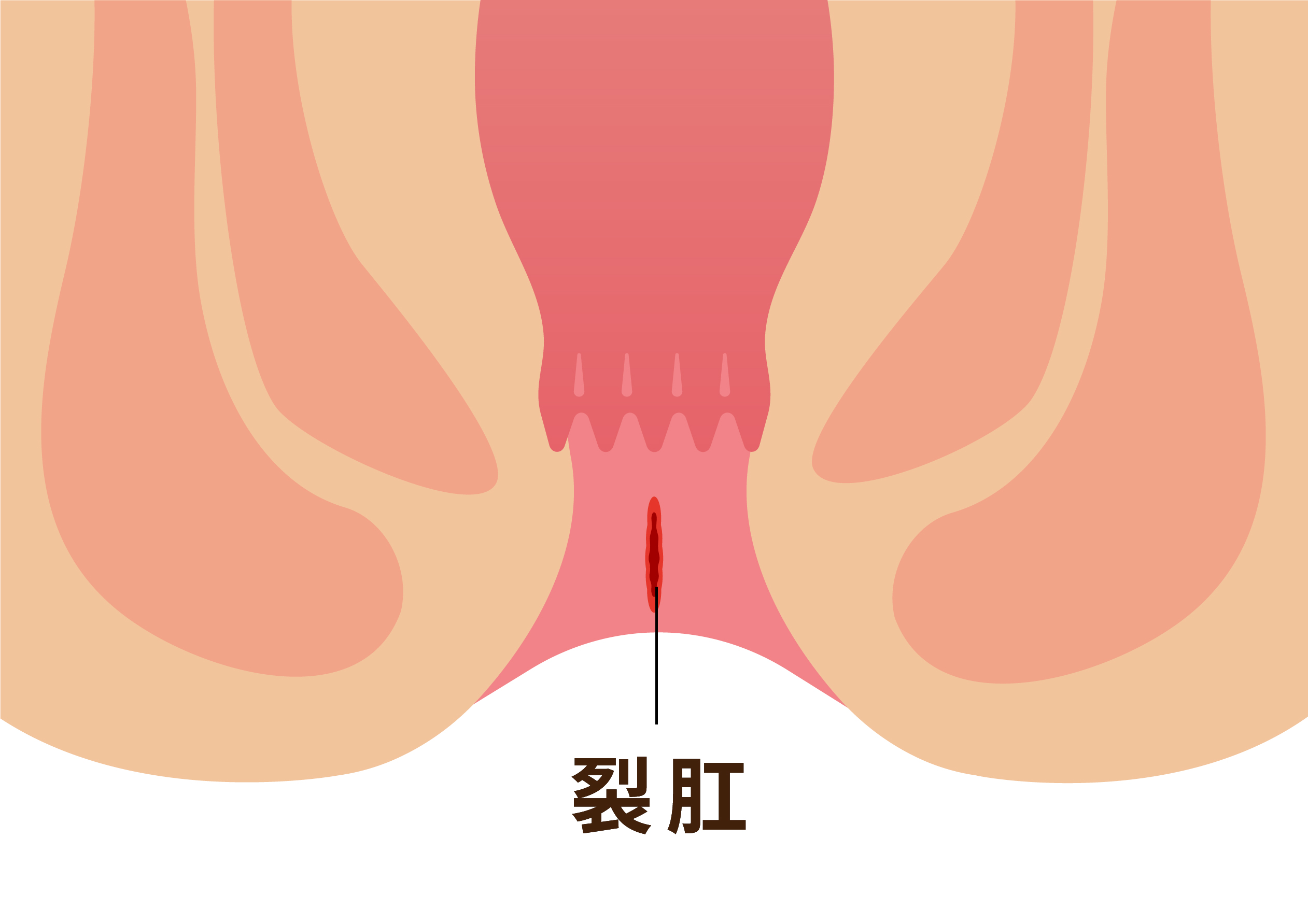 切れ痔図示