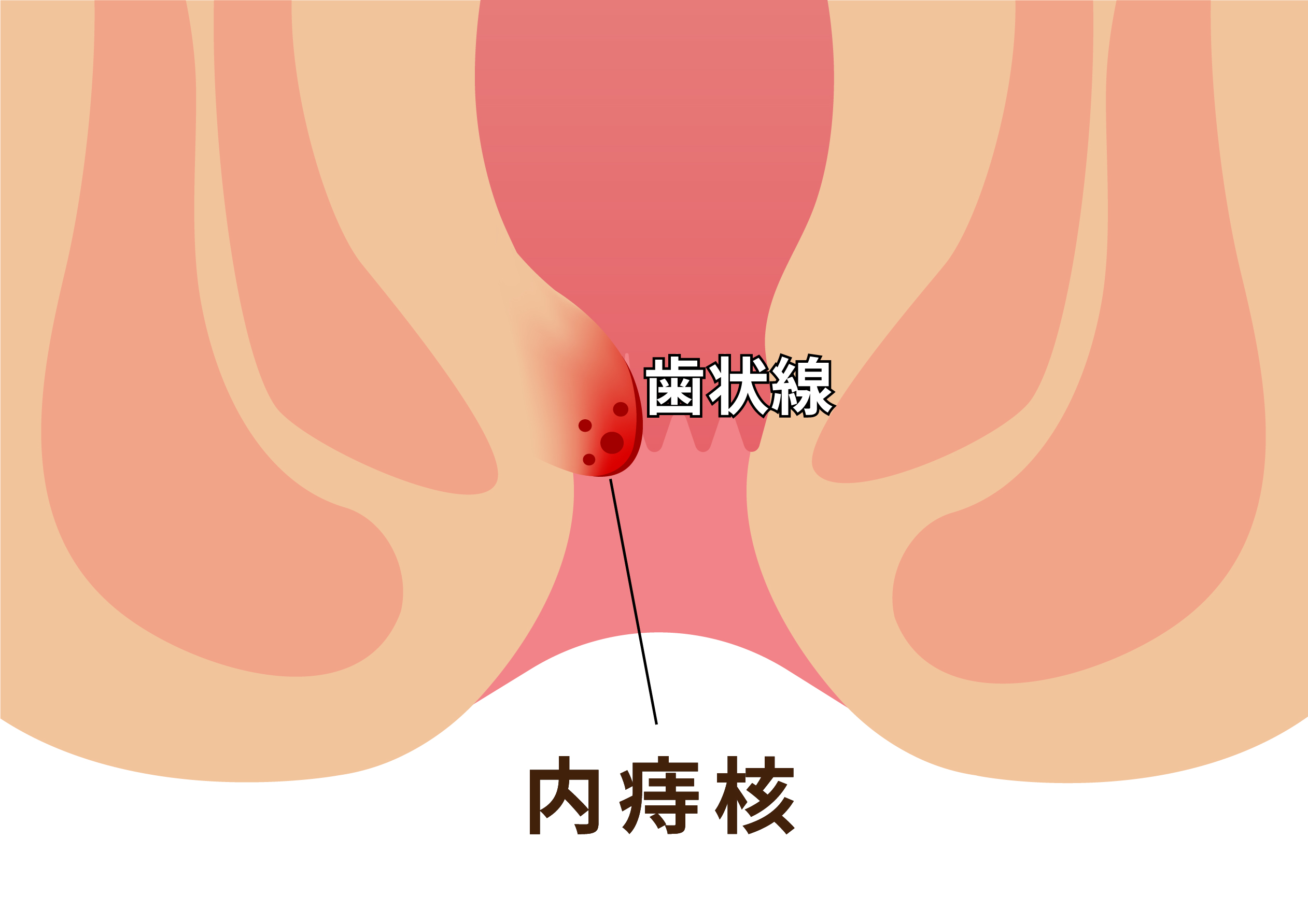 内痔核図示